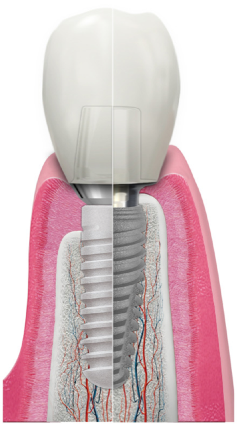Implantat Argon Klein